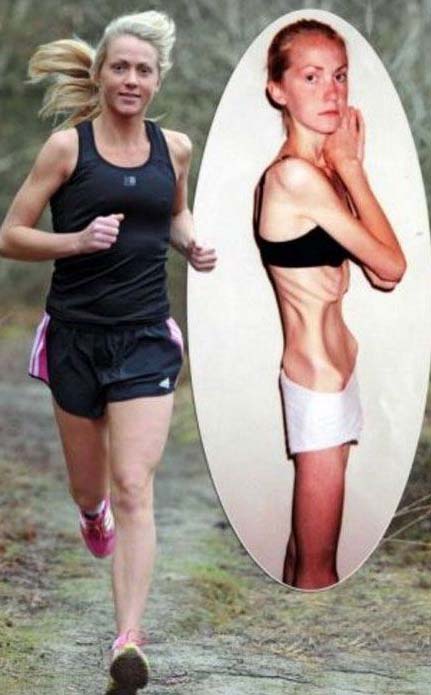 People who beat anorexia - Гарриет Смит боролась с пищевым расстройством